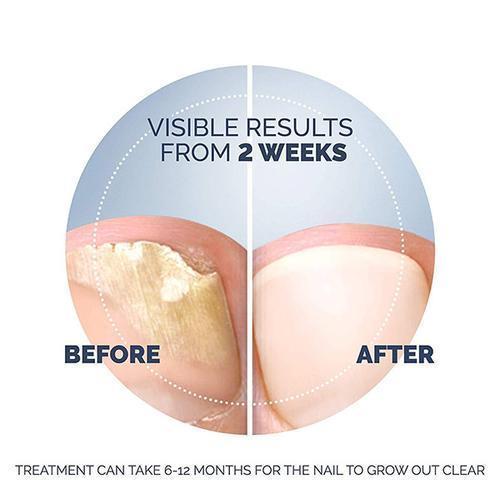 2-Pack Fungal Nail Treatment - Image 8